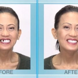 Multi-Shade Temporary Tooth Replacement Kit - Image 6