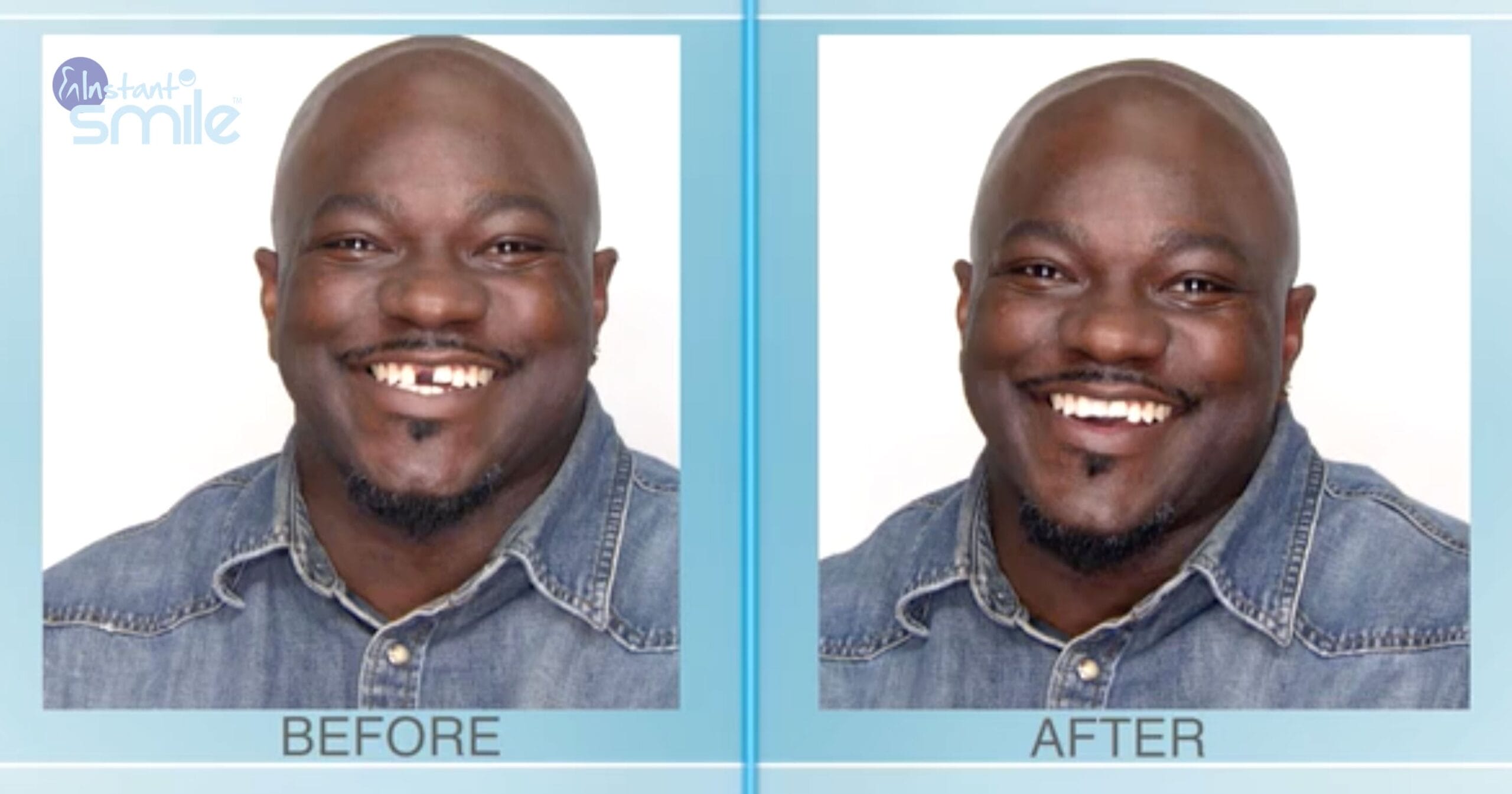 Teeth Repair Kit, Temporary Teeth replacement kit, Nigeria
