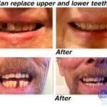 Multishade-upper-and-lower-teeth
