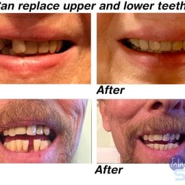 Multi-Shade Temporary Tooth Replacement Kit - Image 4