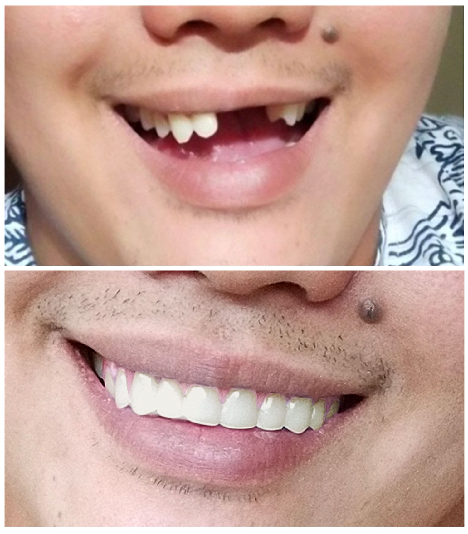 Natural Shade - Instant Smile Comfort Fit Flex - Instant Smile