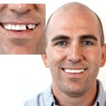 Erik-Before-and-After-Replace-A-Tooth