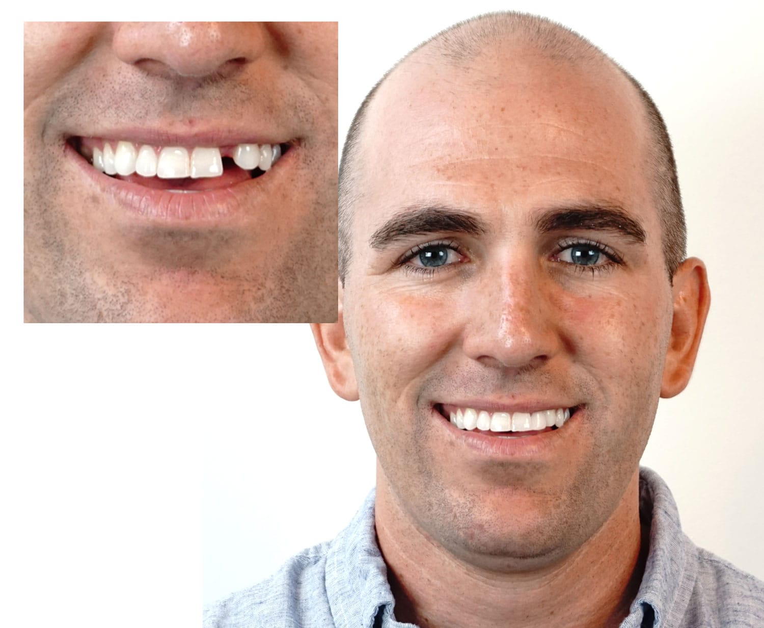 Instant Smile MULTISHADE Patented Temporary Tooth Repair Kit. A Realistic  Looking Fix for a Missing or