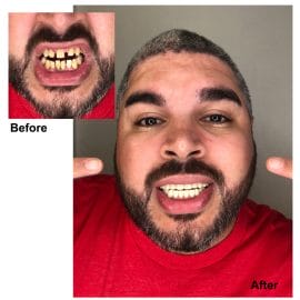 Instant Smile Flex Natural - Upper and Lower Set - Image 3